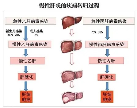 慢性肝炎.jpg