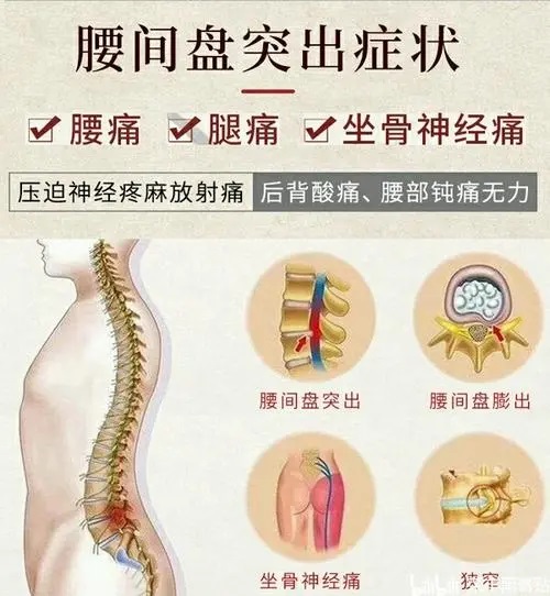 腰椎间盘突出3.jpg