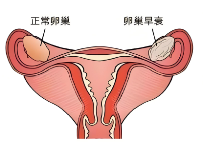 卵巢早衰.png